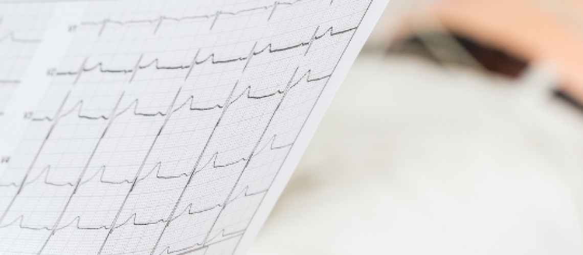 Fibrilação Atrial